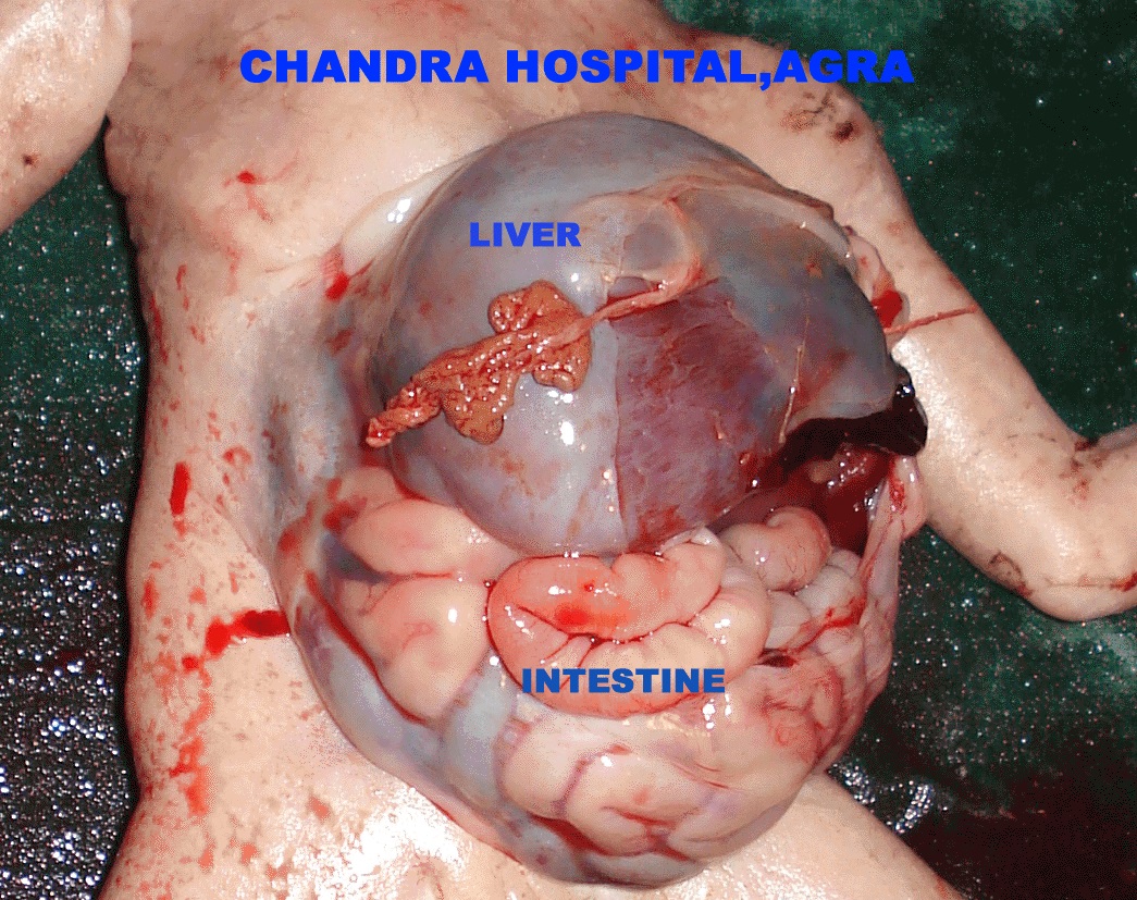 Omphalocele